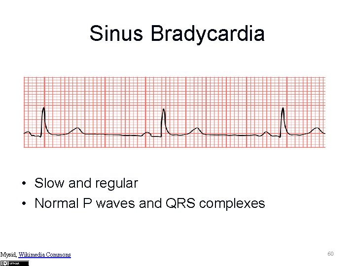 Sinus Bradycardia • Slow and regular • Normal P waves and QRS complexes Mysid,
