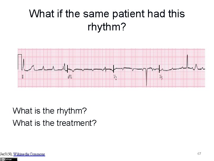 What if the same patient had this rhythm? What is the rhythm? What is