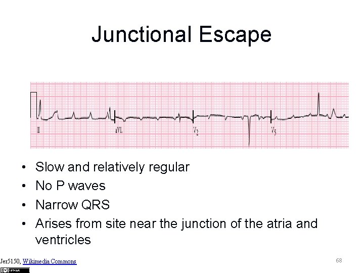 Junctional Escape • • Slow and relatively regular No P waves Narrow QRS Arises