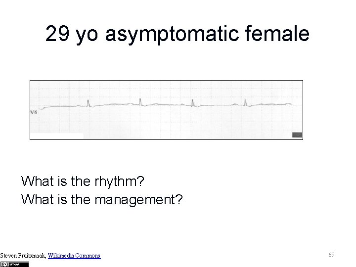 29 yo asymptomatic female What is the rhythm? What is the management? Steven Fruitsmaak,