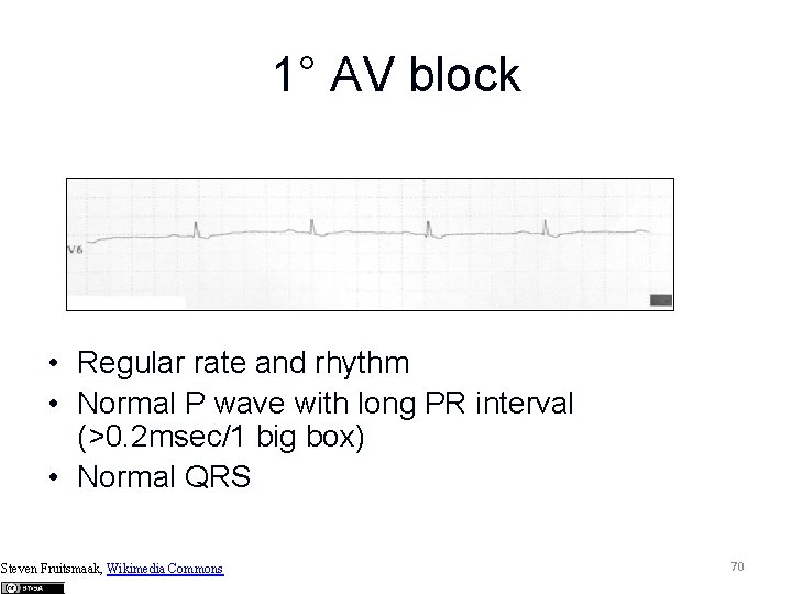 1° AV block • Regular rate and rhythm • Normal P wave with long