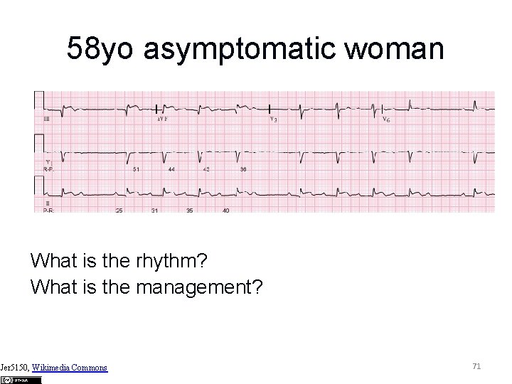 58 yo asymptomatic woman What is the rhythm? What is the management? Jer 5150,