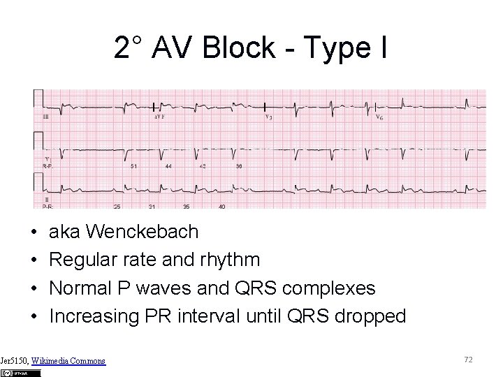 2° AV Block - Type I • • aka Wenckebach Regular rate and rhythm