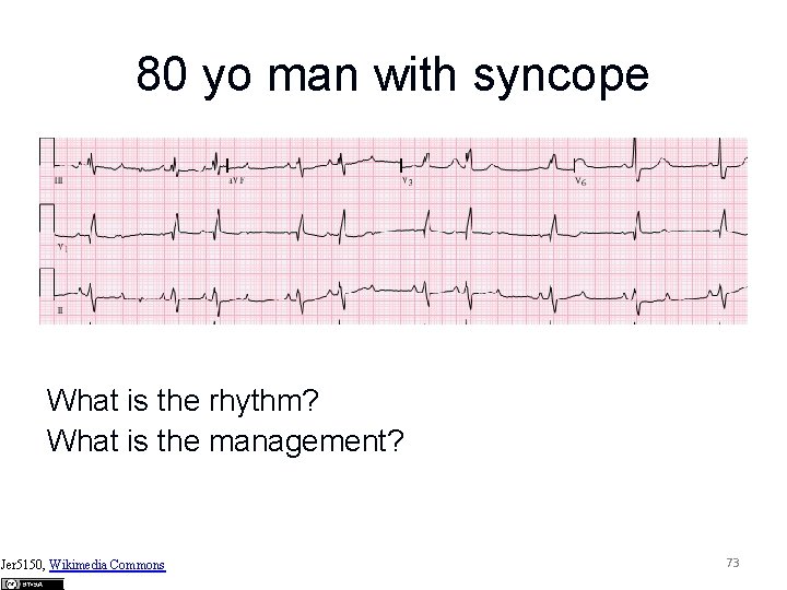 80 yo man with syncope What is the rhythm? What is the management? Jer