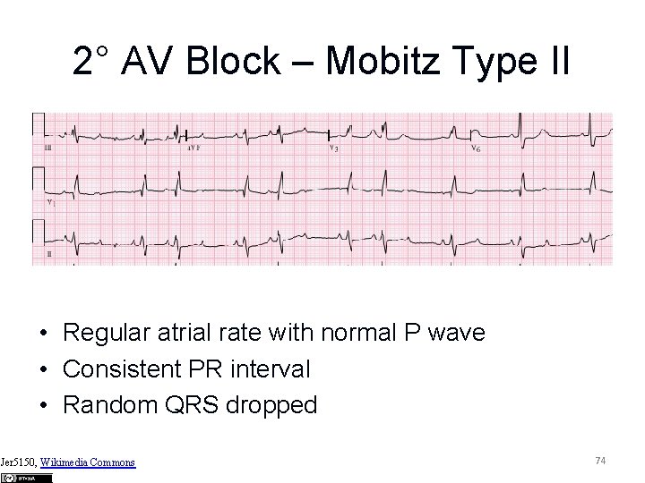 2° AV Block – Mobitz Type II • Regular atrial rate with normal P