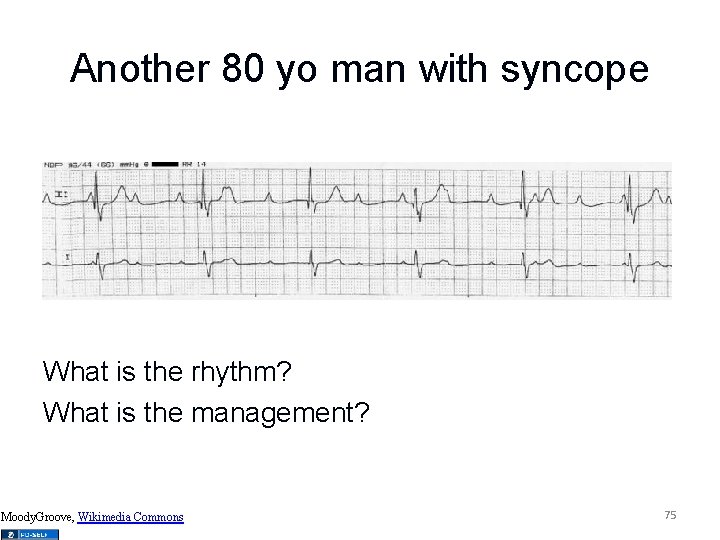 Another 80 yo man with syncope What is the rhythm? What is the management?