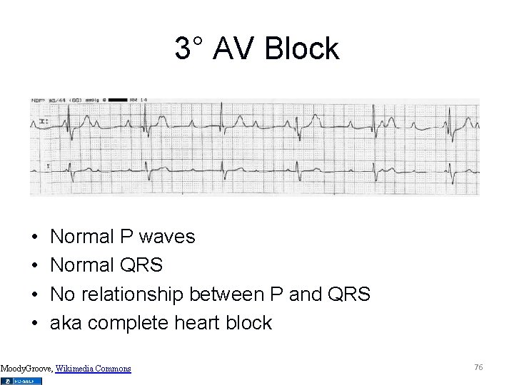 3° AV Block • • Normal P waves Normal QRS No relationship between P