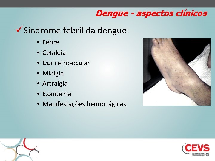 Dengue - aspectos clínicos ü Síndrome febril da dengue: • • Febre Cefaléia Dor