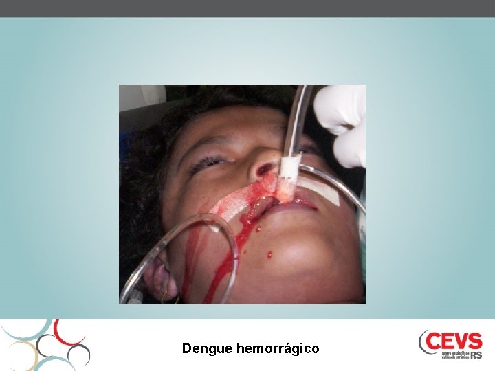 Dengue hemorrágico 18 