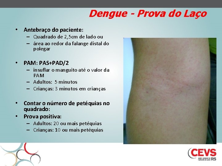 Dengue - Prova do Laço • Antebraço do paciente: – Quadrado de 2, 5