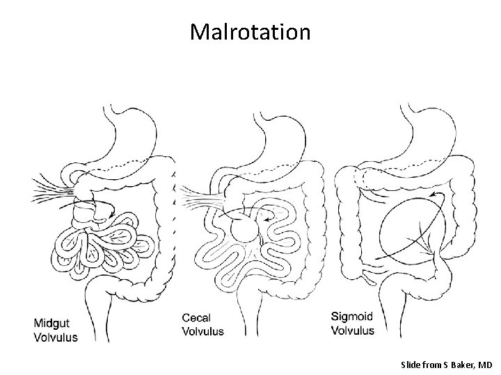 Malrotation Slide from S Baker, MD 