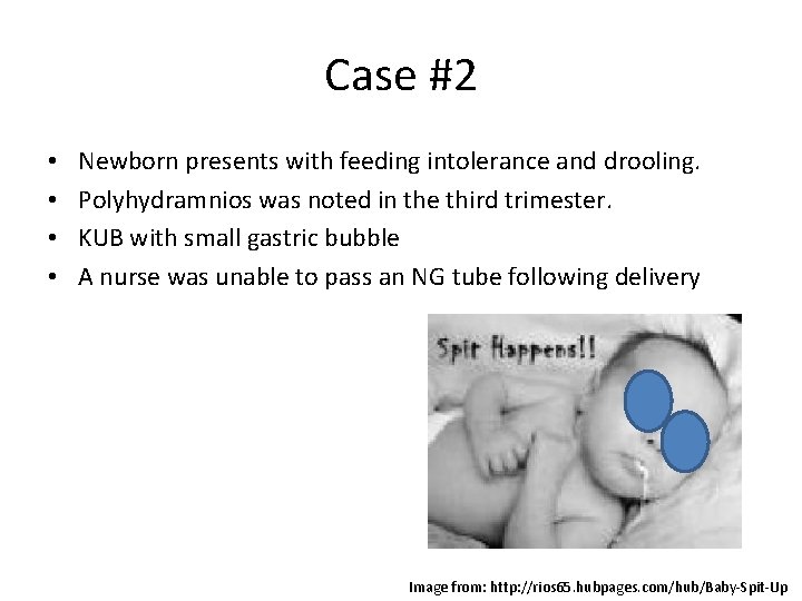 Case #2 • • Newborn presents with feeding intolerance and drooling. Polyhydramnios was noted