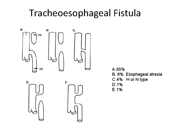 Tracheoesophageal Fistula A. 85% B. 8% Esophageal atresia C. 4% H or N type