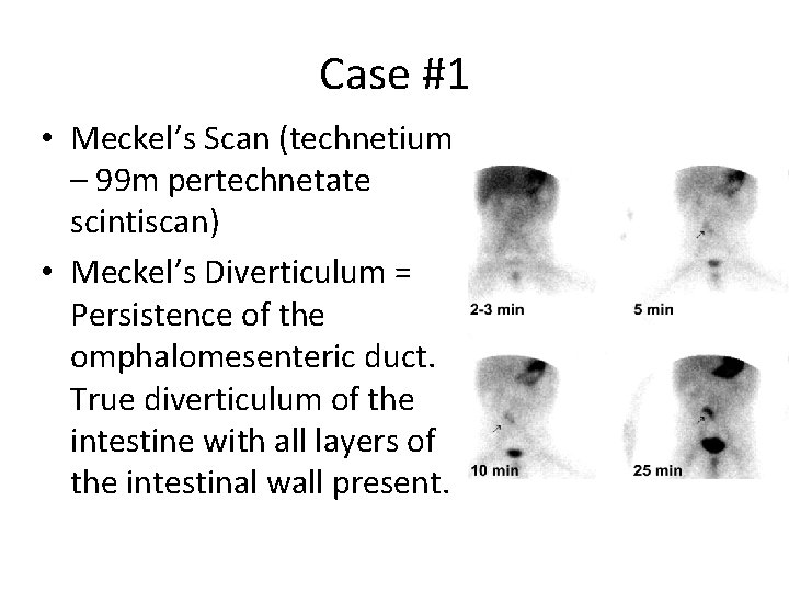 Case #1 • Meckel’s Scan (technetium – 99 m pertechnetate scintiscan) • Meckel’s Diverticulum