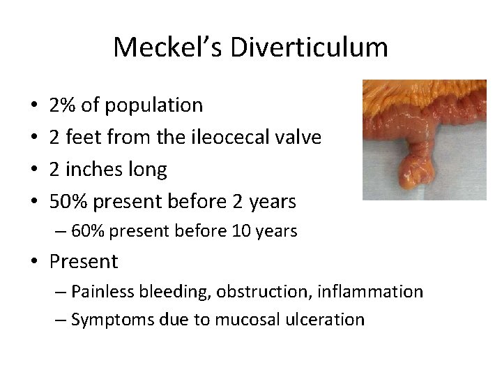 Meckel’s Diverticulum • • 2% of population 2 feet from the ileocecal valve 2