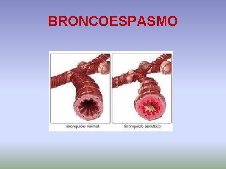 BRONCOESPASMO 