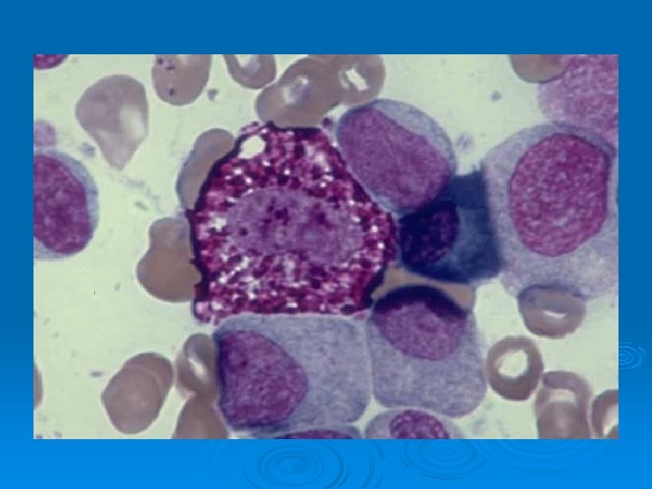 Mast cell, Normal marrow One mast cell partially degranulated (vacuolated areas), 1 plasma cell,