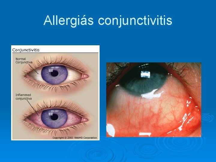Allergiás conjunctivitis 