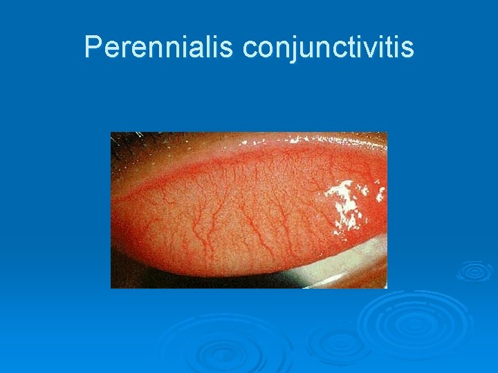 Perennialis conjunctivitis 