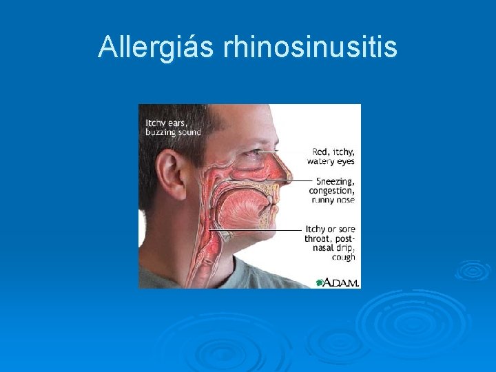 Allergiás rhinosinusitis 