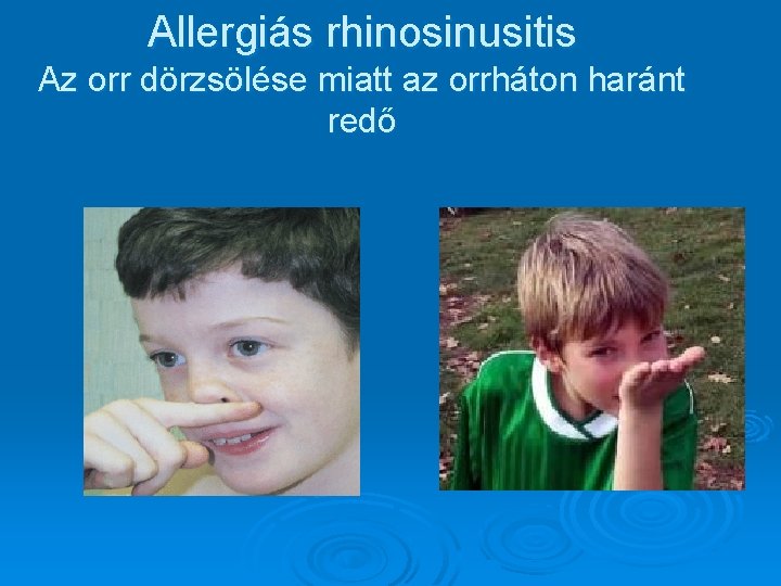 Allergiás rhinosinusitis Az orr dörzsölése miatt az orrháton haránt redő 