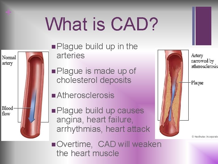 + What is CAD? n Plague arteries build up in the n Plague is