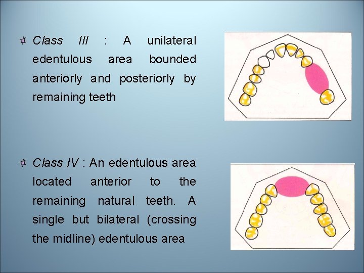 Class III : edentulous A unilateral area bounded anteriorly and posteriorly by remaining teeth