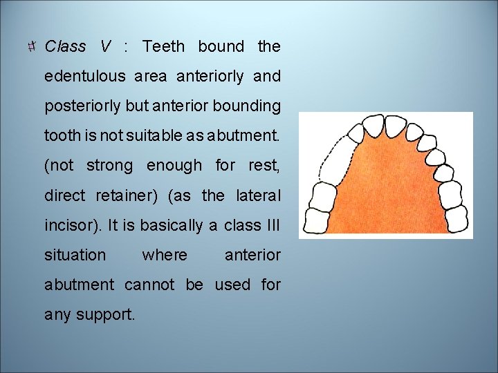 Class V : Teeth bound the edentulous area anteriorly and posteriorly but anterior bounding