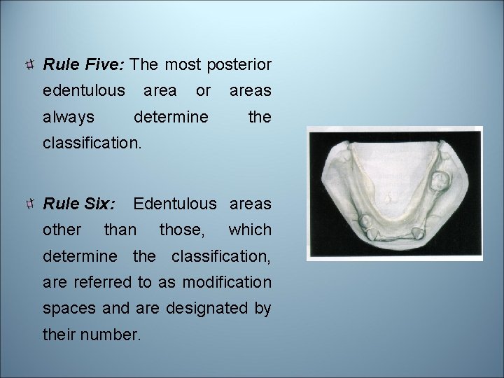 Rule Five: The most posterior edentulous always area or areas determine the classification. Rule