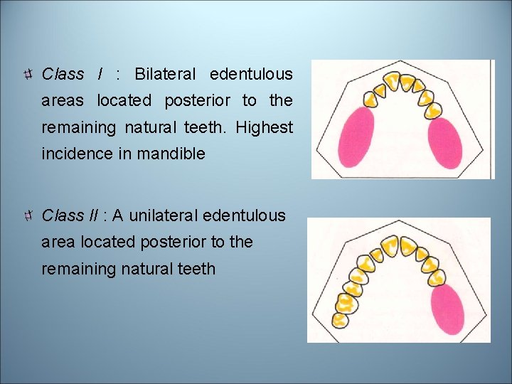 Class I : Bilateral edentulous areas located posterior to the remaining natural teeth. Highest