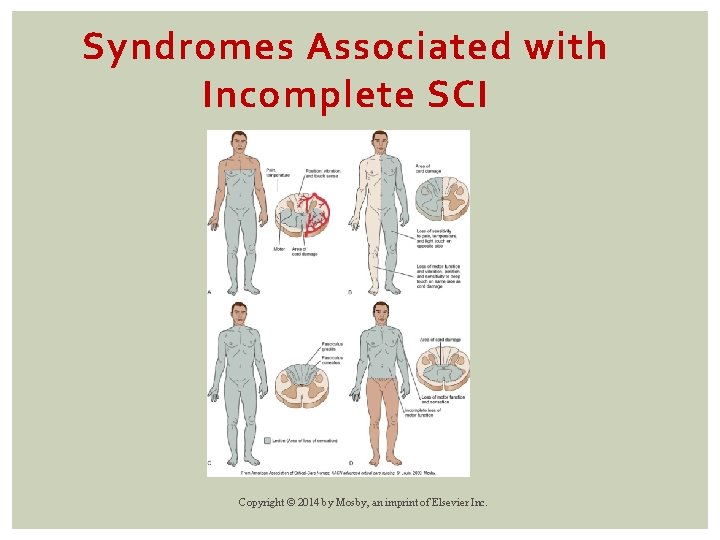Syndromes Associated with Incomplete SCI Copyright © 2014 by Mosby, an imprint of Elsevier