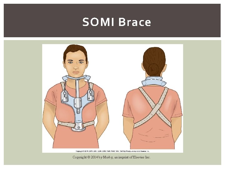 SOMI Brace Copyright © 2014 by Mosby, an imprint of Elsevier Inc. 