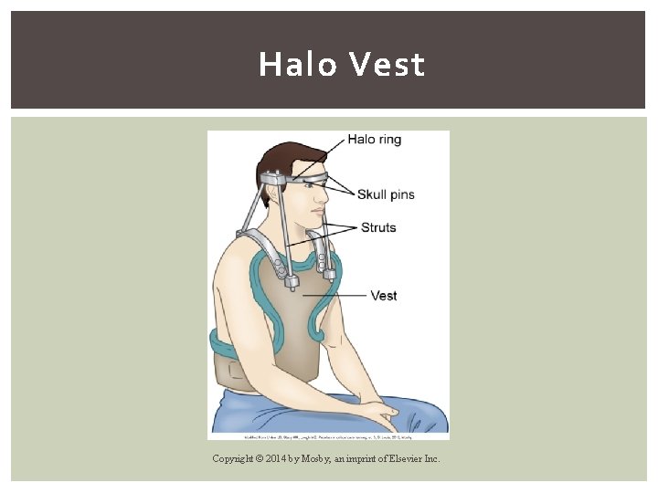 Halo Vest Copyright © 2014 by Mosby, an imprint of Elsevier Inc. 