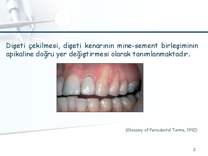 Dişeti çekilmesi, dişeti kenarının mine-sement birleşiminin apikaline doğru yer değiştirmesi olarak tanımlanmaktadır. (Glossary of