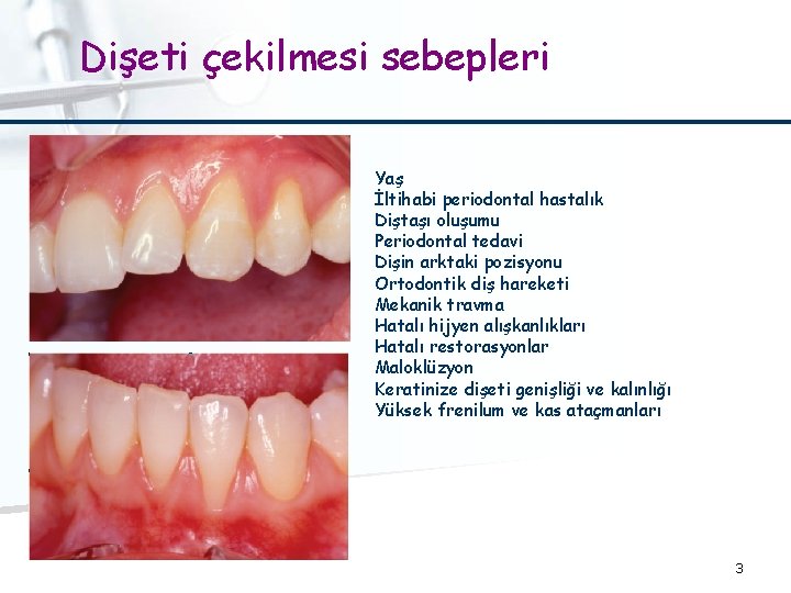 Dişeti çekilmesi sebepleri Yaş İltihabi periodontal hastalık Diştaşı oluşumu Periodontal tedavi Dişin arktaki pozisyonu