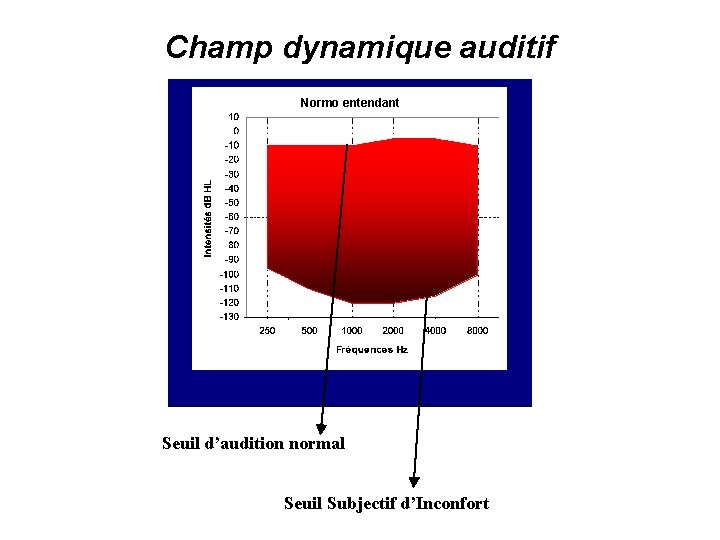 Champ dynamique auditif Normo entendant Seuil d’audition normal Seuil Subjectif d’Inconfort Sujet avec une