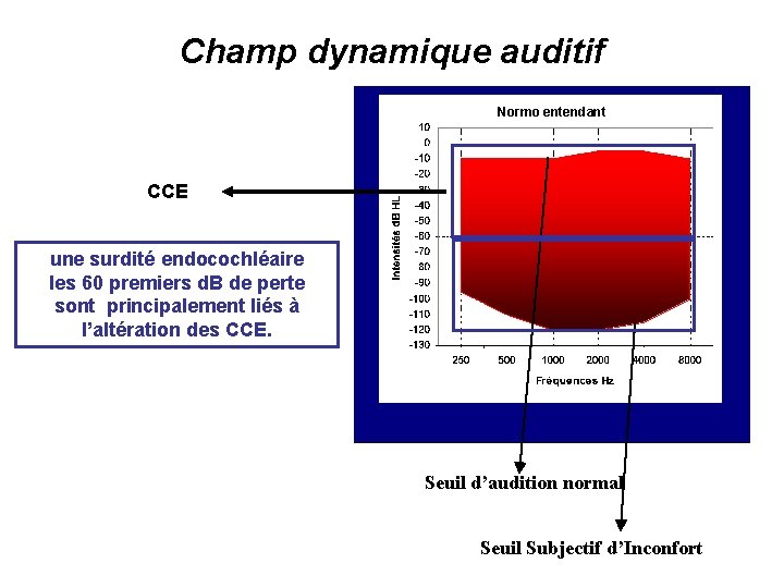 Champ dynamique auditif Normo entendant CCE une surdité endocochléaire les 60 premiers d. B