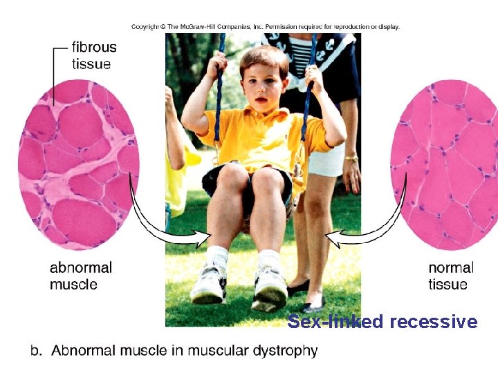 Fig. 26. 14 b Sex-linked recessive 