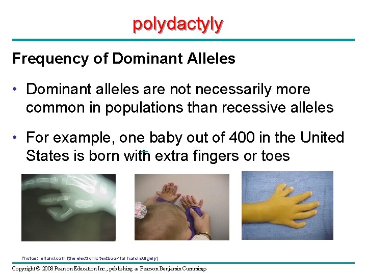 polydactyly Frequency of Dominant Alleles • Dominant alleles are not necessarily more common in