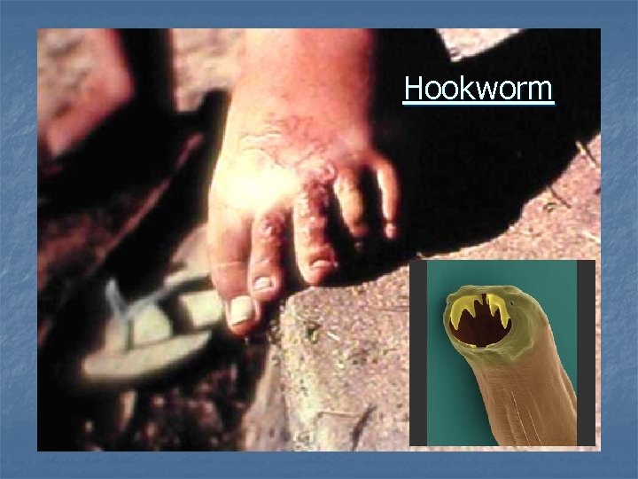 Hookworm 