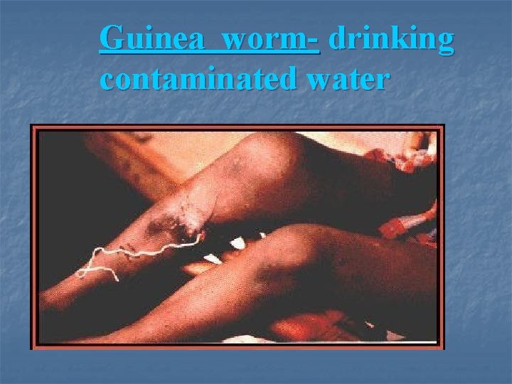 Guinea worm- drinking contaminated water 