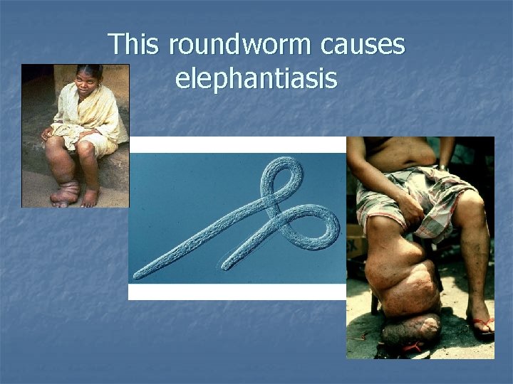 This roundworm causes elephantiasis 