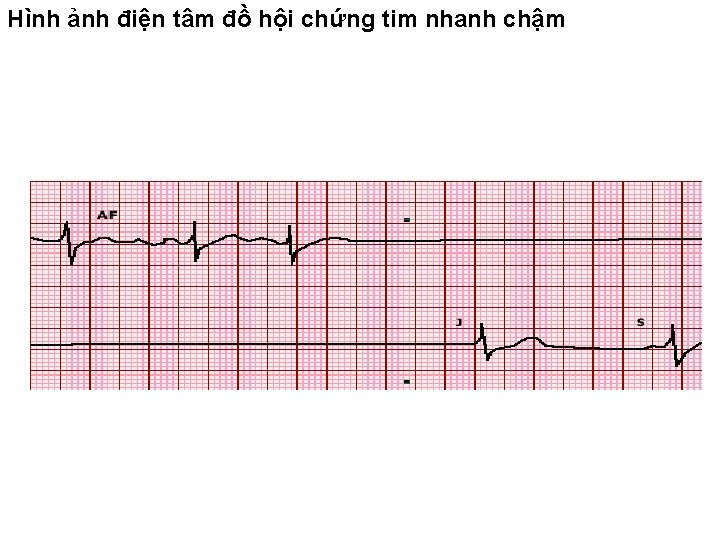 Hình ảnh điện tâm đồ hội chứng tim nhanh chậm 