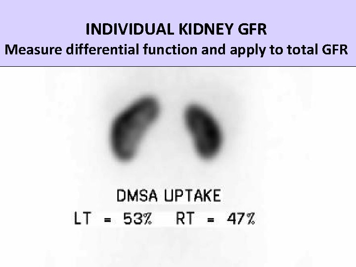 INDIVIDUAL KIDNEY GFR establish function differential function Measure differential and apply to total GFR