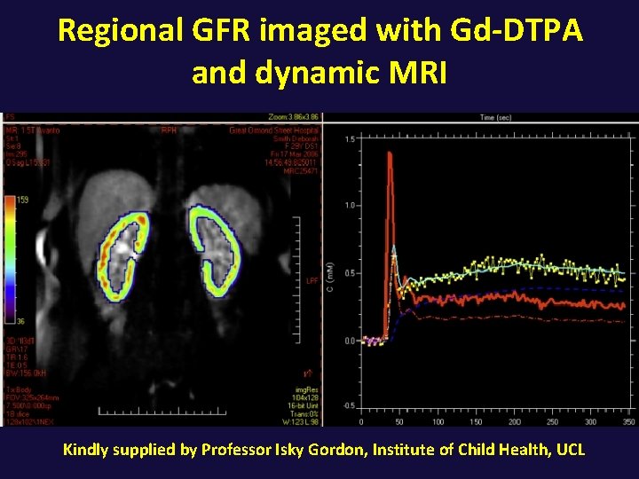 Regional GFR imaged with Gd-DTPA and dynamic MRI Kindly supplied by Professor Isky Gordon,