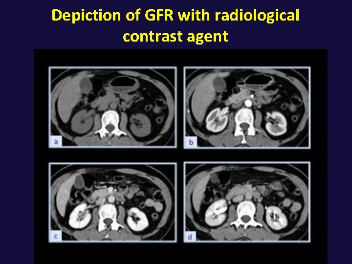 Depiction of GFR with radiological contrast agent 