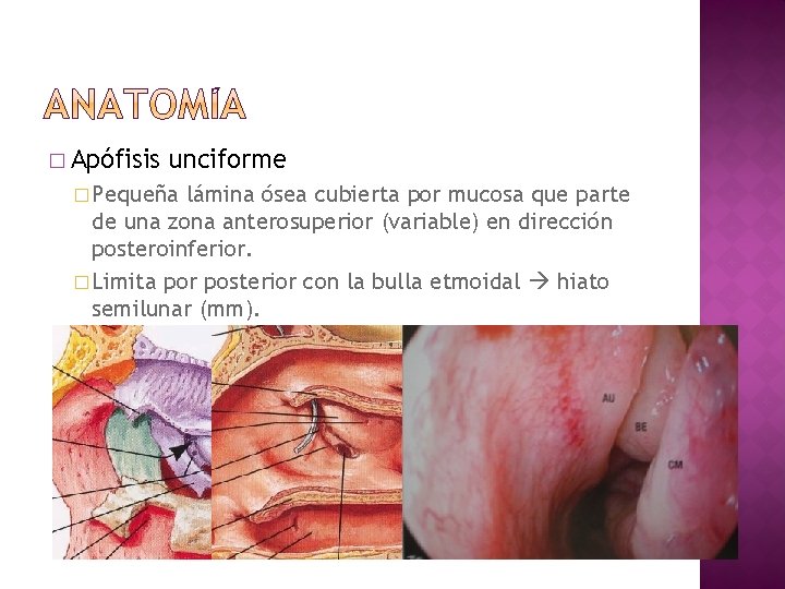 � Apófisis unciforme � Pequeña lámina ósea cubierta por mucosa que parte de una