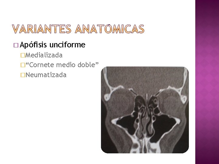� Apófisis unciforme �Medializada �“Cornete medio doble” �Neumatizada 