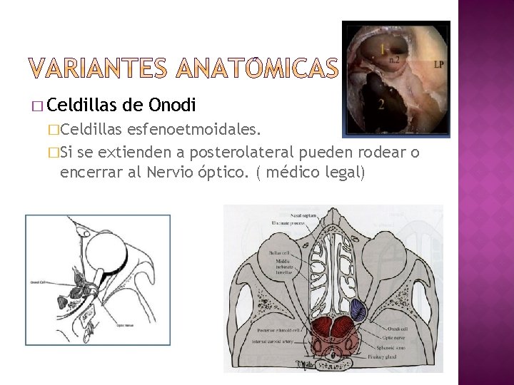 � Celdillas de Onodi �Celdillas esfenoetmoidales. �Si se extienden a posterolateral pueden rodear o