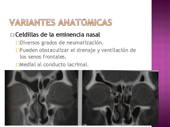 � Celdillas �Diversos de la eminencia nasal grados de neumatización. �Pueden obstaculizar el drenaje